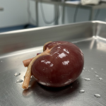 Organ Trafficking: The Global Crisis Hiding in Plain Sight